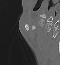 Sesamoid Fracture CT